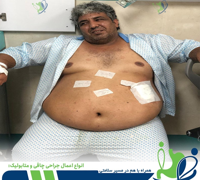 انواع عمل جراحی چاقی و متابولیک - کدام عمل برای چاقی بهتر است - دکتر شهاب شهابی