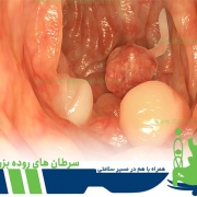 سرطان های روده بزرگ