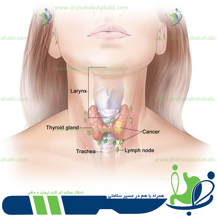  اختلال عملکرد کم کاری تیروئید و چاقی